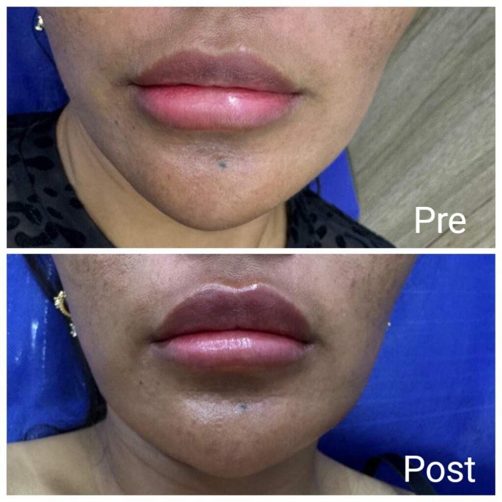 تكبير الشفايف بالفيلر في الغردقة